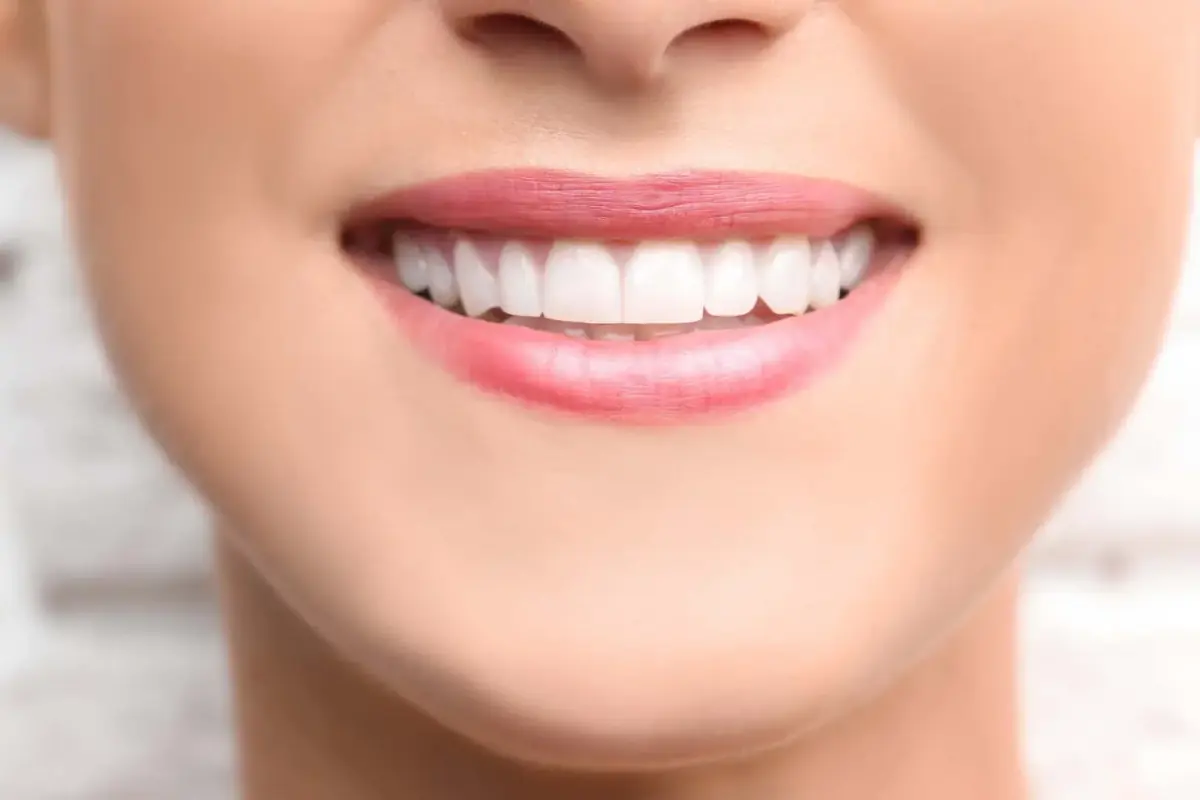 Whitening as a first step toward a smile makeover