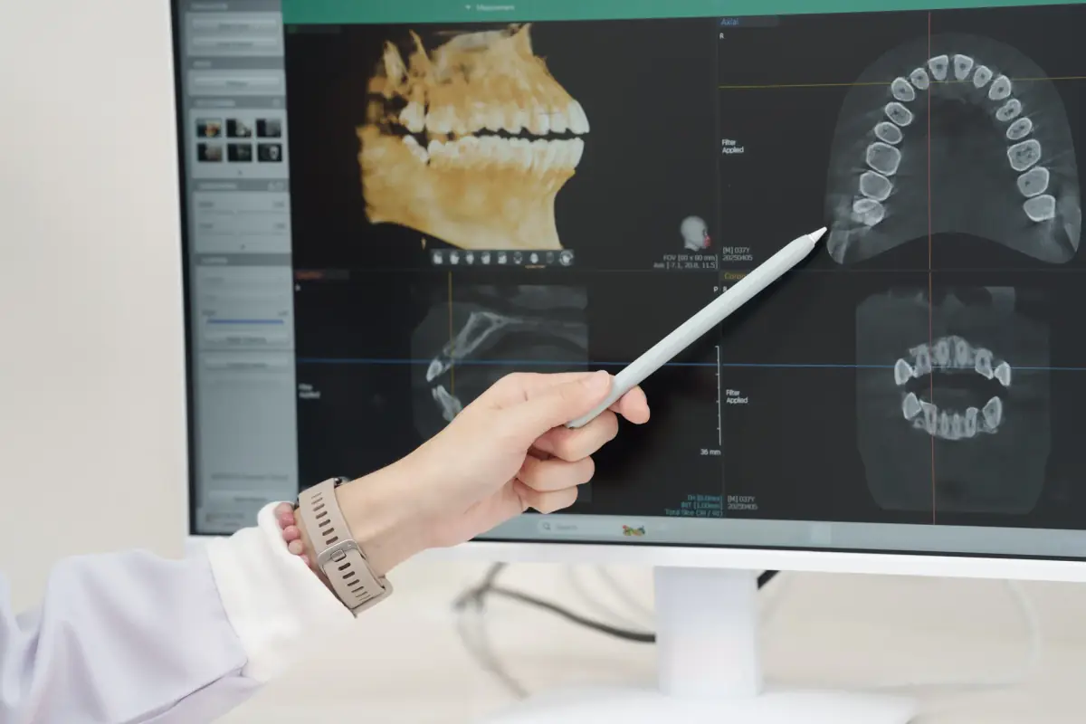 All-on-4 teeth fixed in place