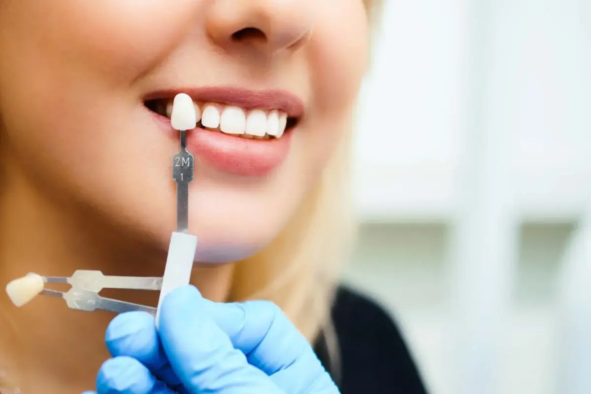 Dentist matching a veneer shade guide to a patient's smile