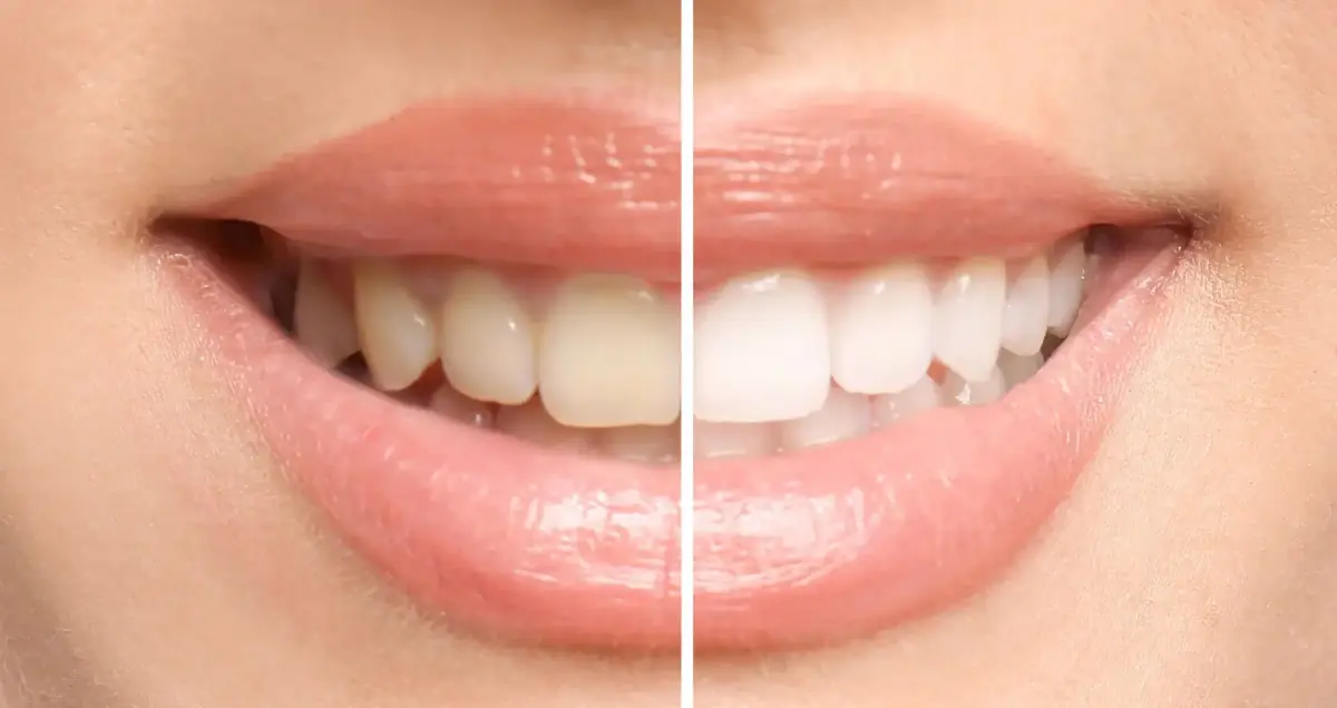 Teeth whitening care at Liberty Dental
