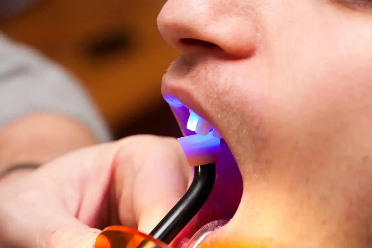 Dental bonding care at Liberty Dental