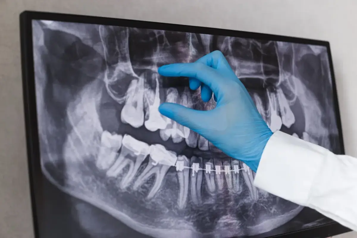 Root canal treatment at Liberty Dental
