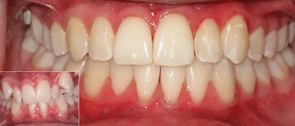 Discreet clear aligner treatment