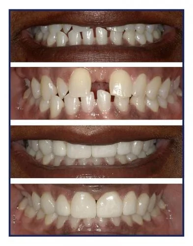 Affordable Invisalign financing