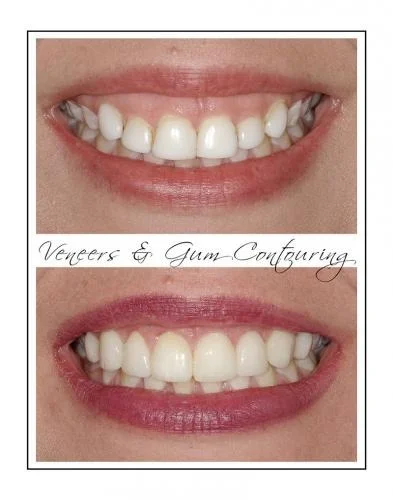 Natural-looking porcelain veneers