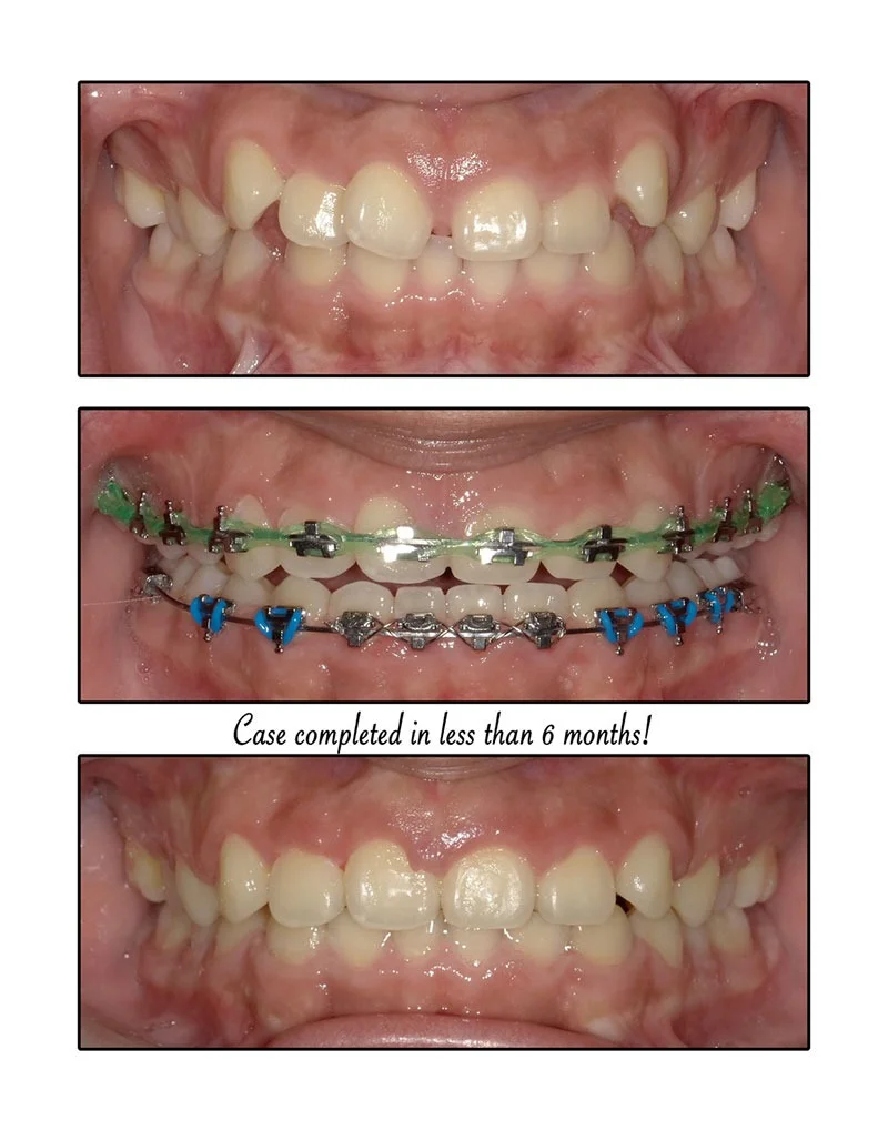 Personalized Invisalign treatment plan
