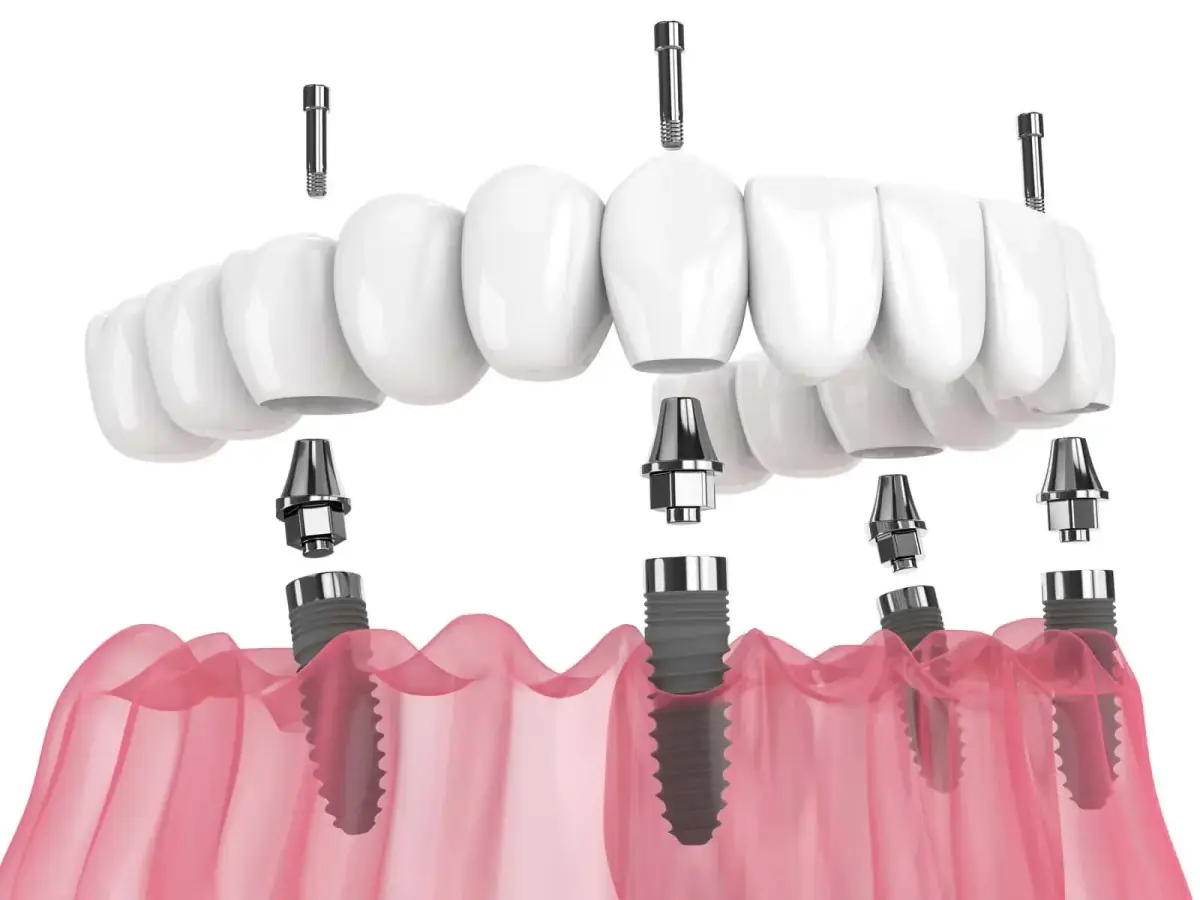 All-on-4 at Liberty Dental