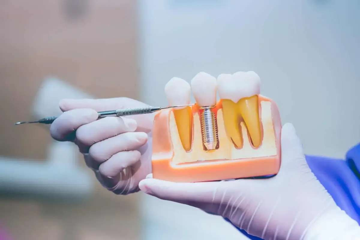 Dental implant care at Liberty Dental