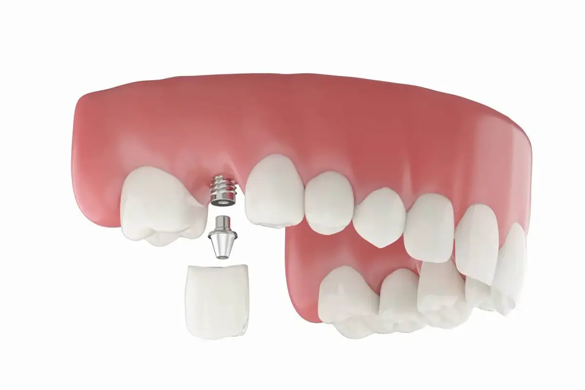Single Tooth Implant at Liberty Dental