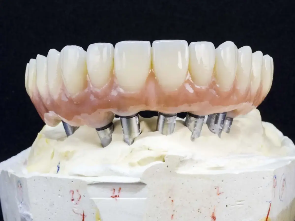 Secure, comfortable implant-supported denture