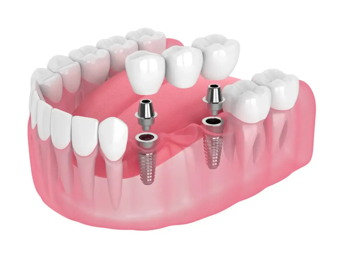 Implant-Supported Dentures at Liberty Dental
