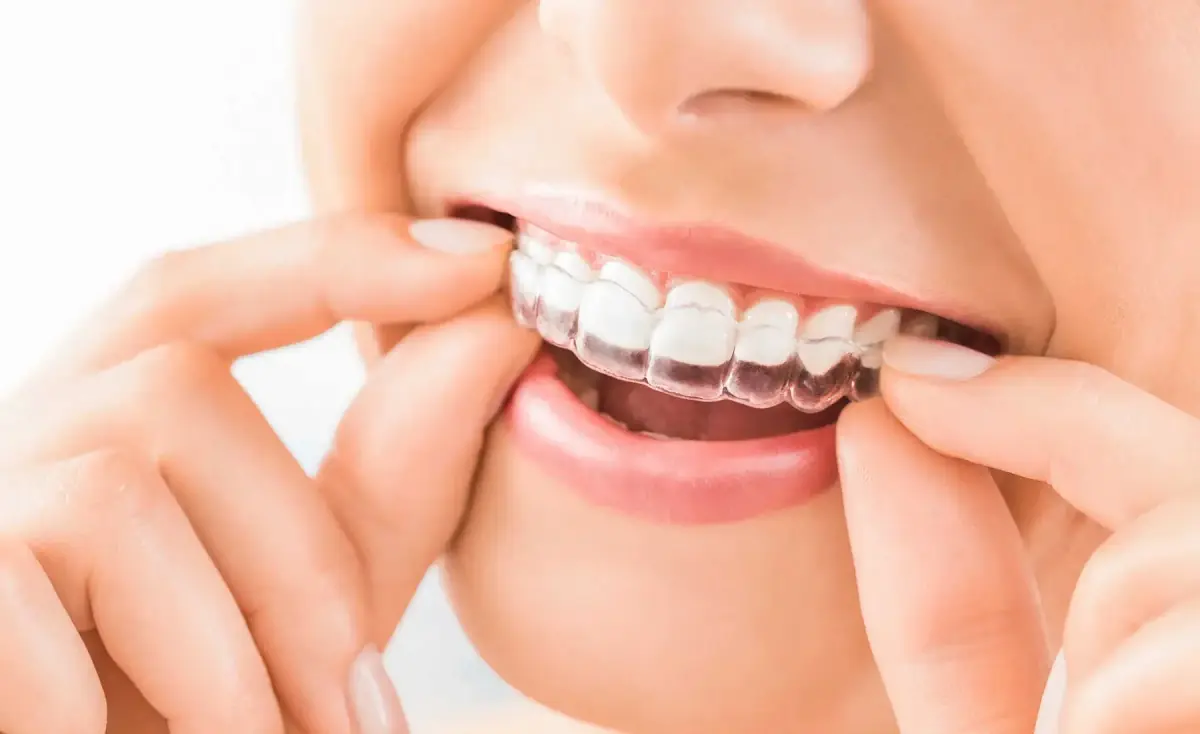 Invisalign clear aligner care at Liberty Dental