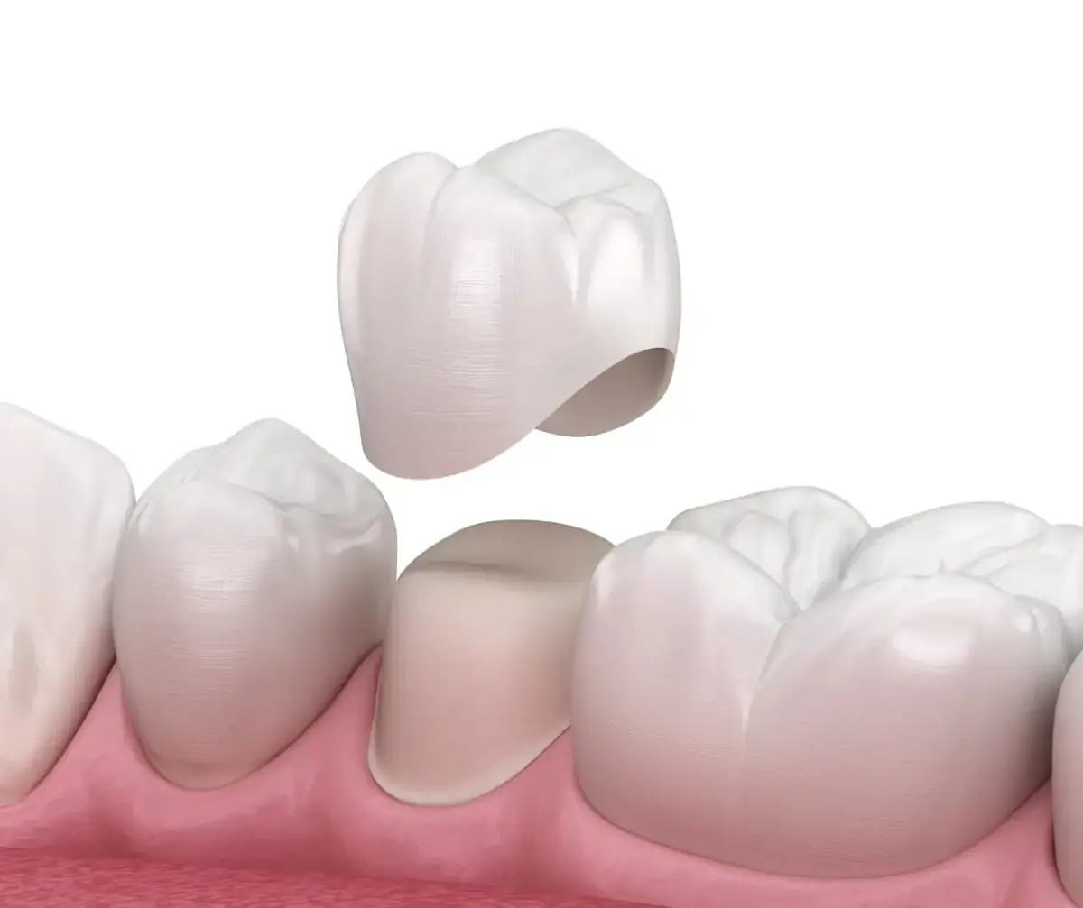 Same-day CEREC crown at Liberty Dental